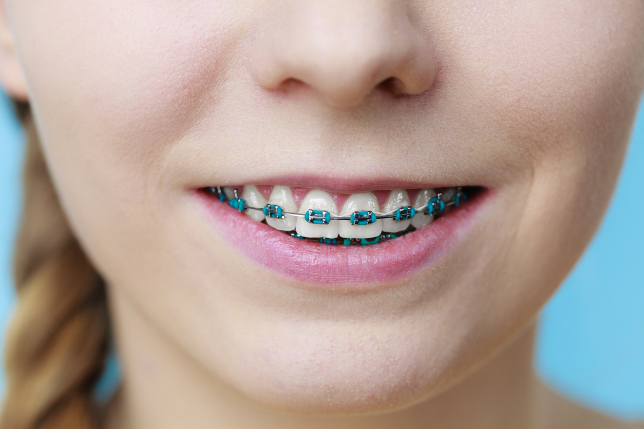 A young girl smiling with blue braces on for restorative dental care.